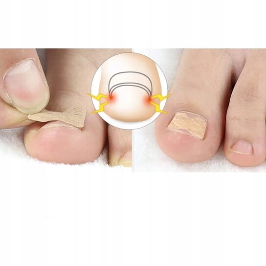 Полоски от вросших ногтей, пластыри для пряжек, 10 шт. FootService
Полоски от вросших ногтей, пластыри для пряжек, 10 шт. FootService