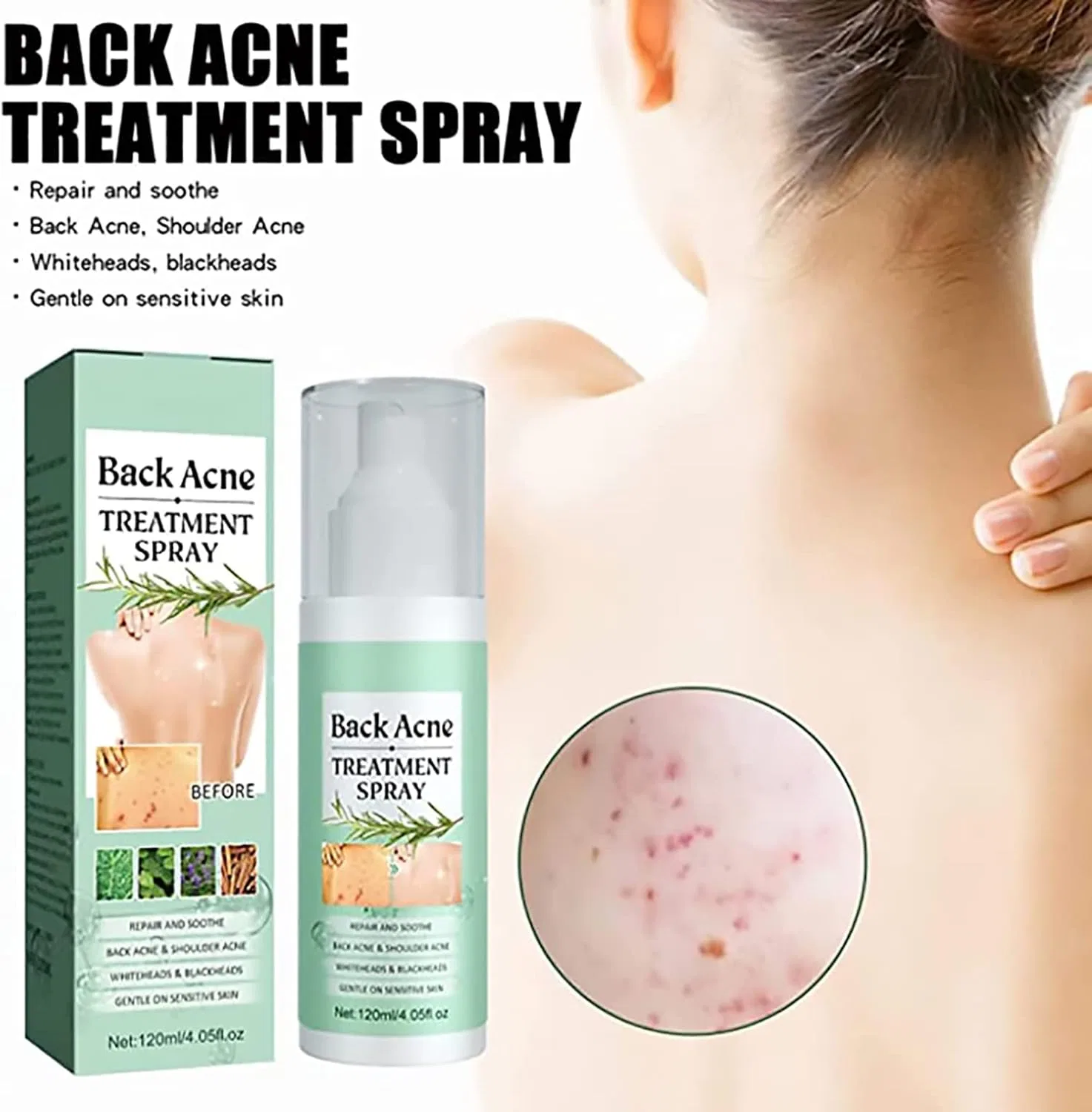 Спрей для лечения акне на спине Toxiklenz Back Acne Treatment Spray, 120 мл (3 шт.) ‎Sovtay, 3 Pieces. — фото 2
