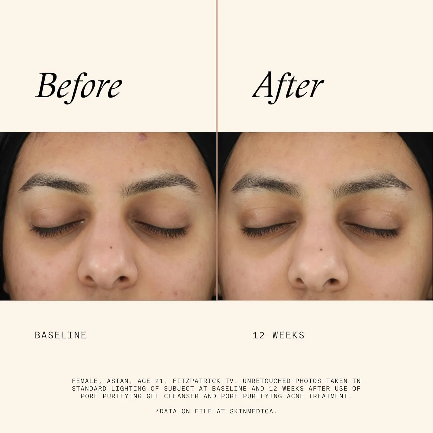 Гель для умывания Skinmedica — Очищающий гель для пор - это очищающее средство с клинически доказанными ингредиентами, 140 мл — фото 4