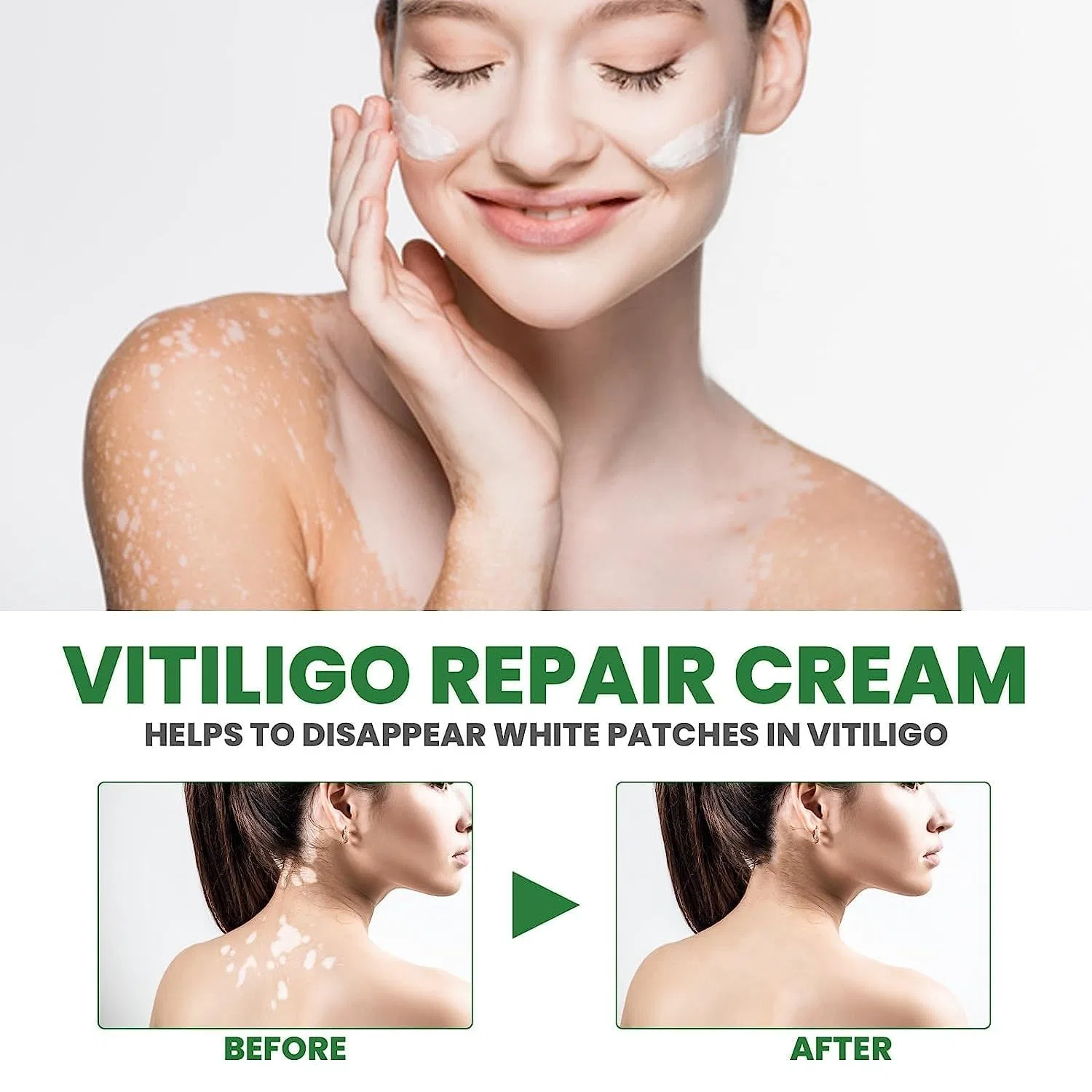Крем для лица Ashopfun — Для лечения витилиго «Vitiligo Fix Revitalize Elixir» , 3 Pieces, 15 г — фото 3