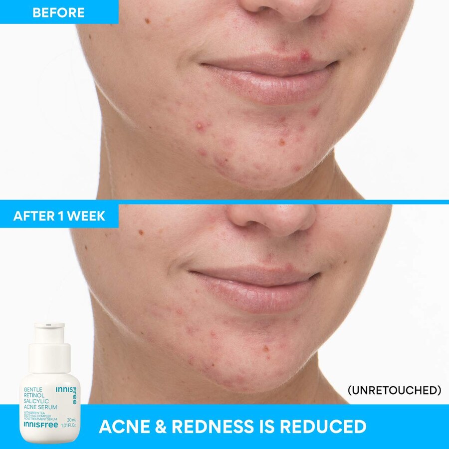 Тоник Innisfree — Мягкая от акне с ретинолом и салициловой кислотой, 30 мл — фото 2