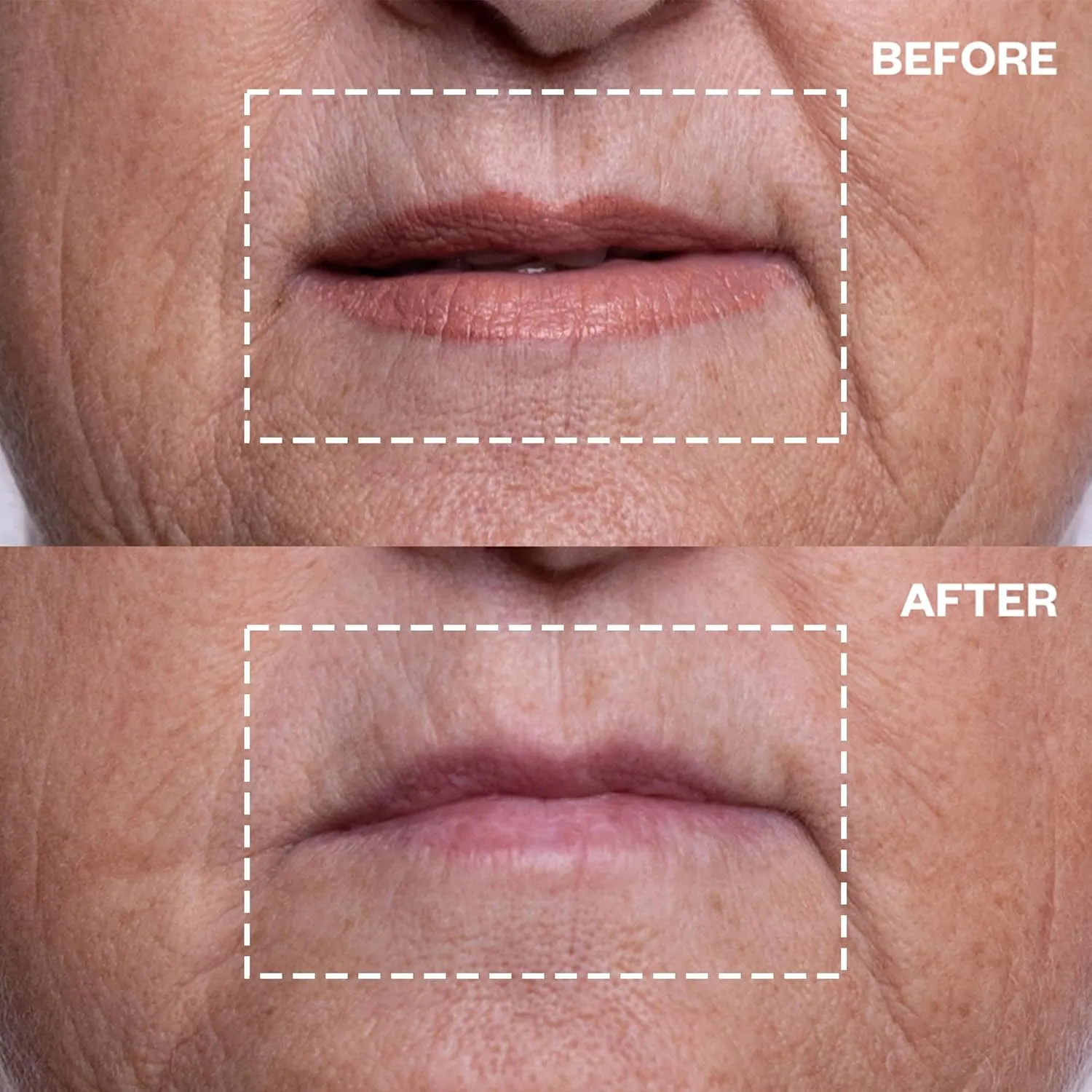 Wrinkles Schminkles патчи для губ и рта от морщин - многоразовые силиконовые подушечки для заметного уменьшения морщин и профилактики морщин вокруг губ для молодой и гладкой кожи (2 шт) 2 шт. (1 шт.) — фото 3
