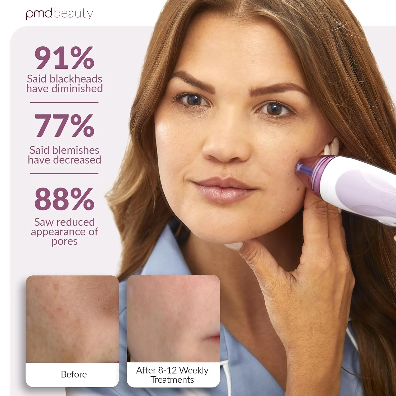 PMD Beauty Personal Microderm Pro - Инструмент для микродермабразии для домашнего использования, отшелушивающий скраб для лица и тела., Lavender — фото 4