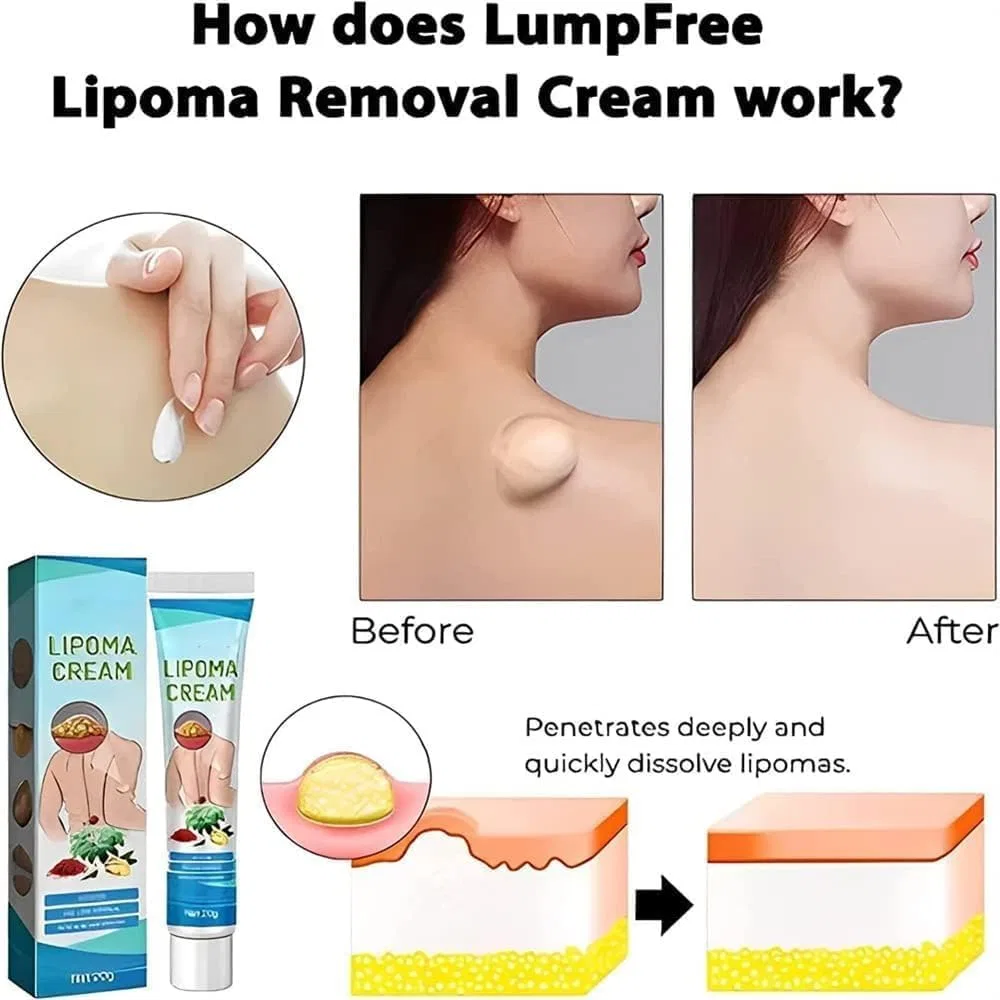 Крем для удаления липом от Lumpfree Cream (2 шт.) Xbaking, 2 Pieces. — фото 2