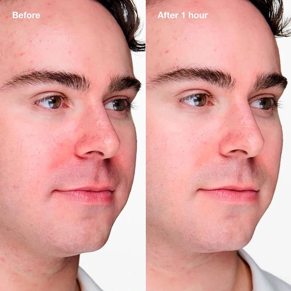 Гель для лица от несовершенств Clinique Anti-Blemish Solutions Clinical, 20 мл — фото 2