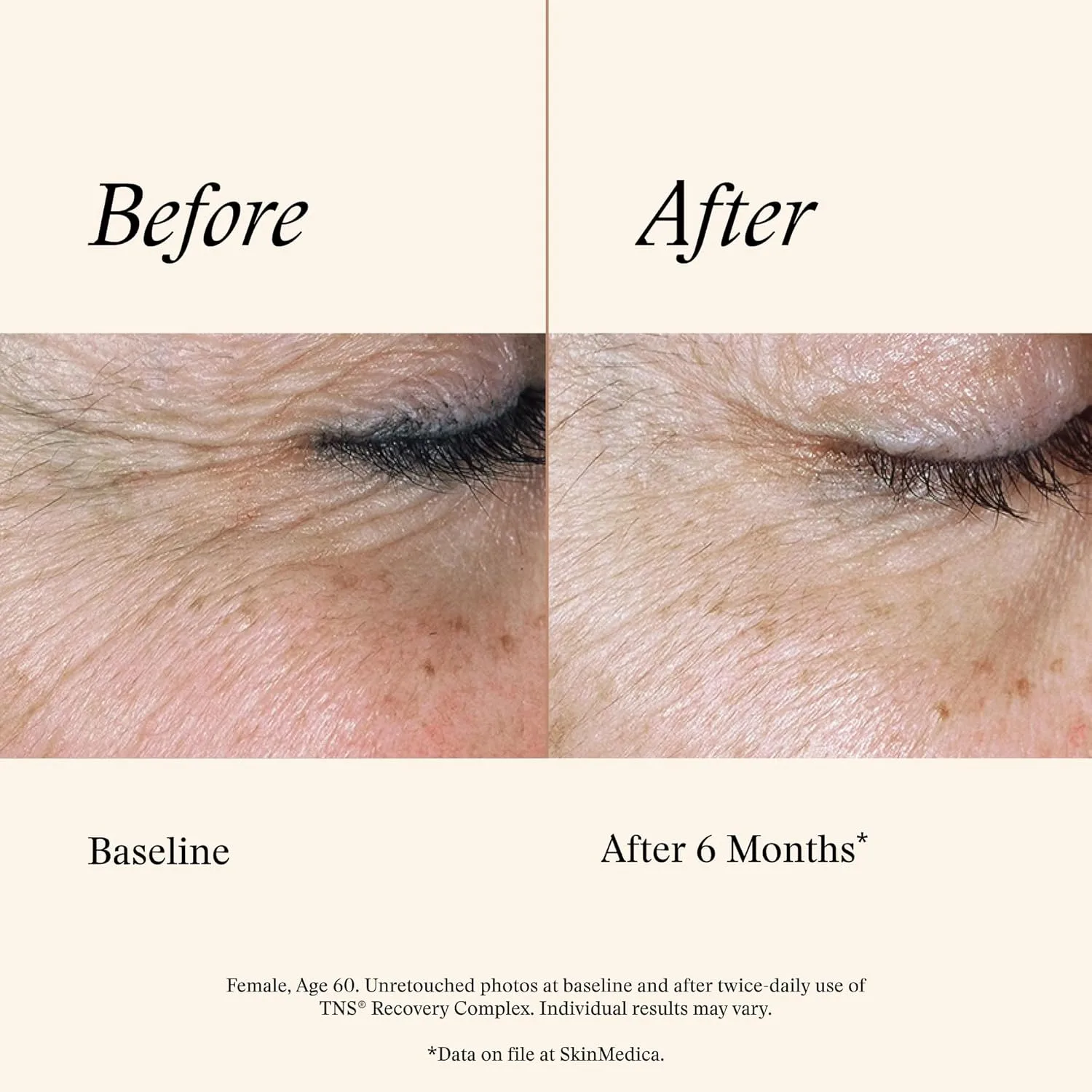 SkinMedica TNS Recovery Complex - технология ухода за кожей на основе фибробластов, содержащая экзосомы и факторы роста для заметного уменьшения мелких морщин, НОВАЯ УПАКОВКА, 28 г — фото 4
