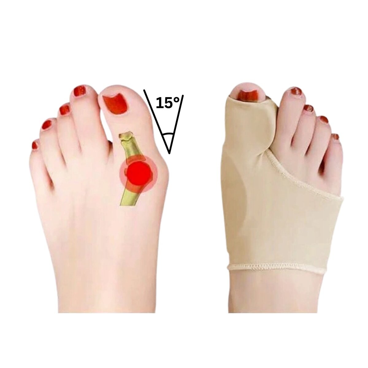 Повязка на бурсит с клиновидным ортезом, корректор Hallux Valgus, разделитель пальцев ног Livoyn — фото 3