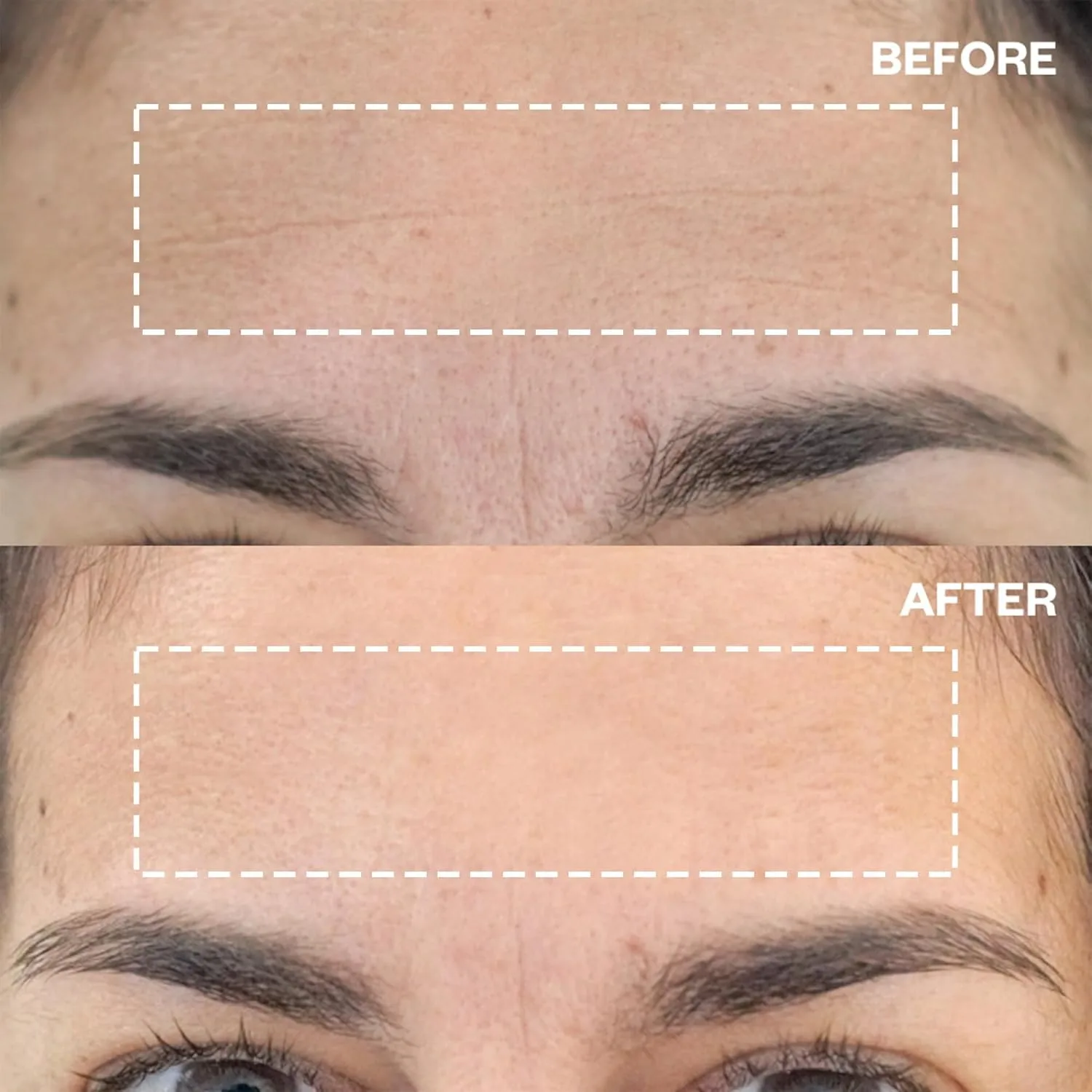 Пластыри от морщин Wrinkles Schminkles для лба, 4 шт., многоразовые гипоаллергенные силиконовые разглаживающие подушечки для уменьшения мимических морщин и подтяжки лица на ночь. 2 шт. (4 шт.) — фото 3