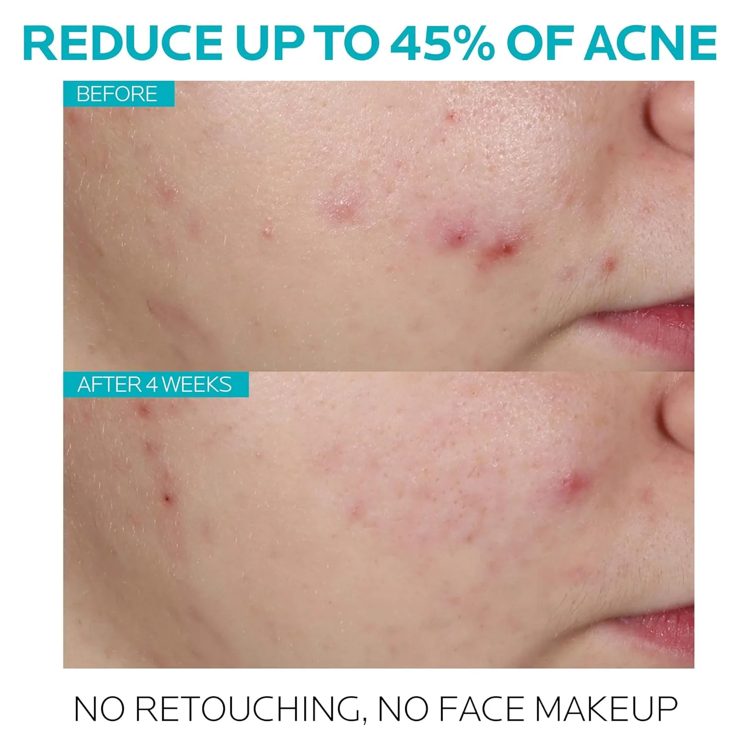 Сыворотка La Roche-Posay — От прыщей Effaclar с , % салициловой кислотой, с гликолевой кислотой и ниацинамидом — фото 2