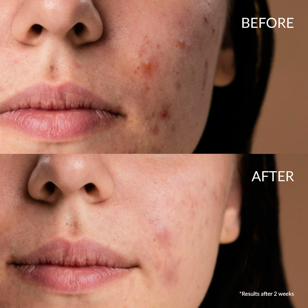 Сыворотка — Ирен Шизен, против прыщей – Clearer Days Anti-Blemish Serum, Inna Marka, 20 мл — фото 2