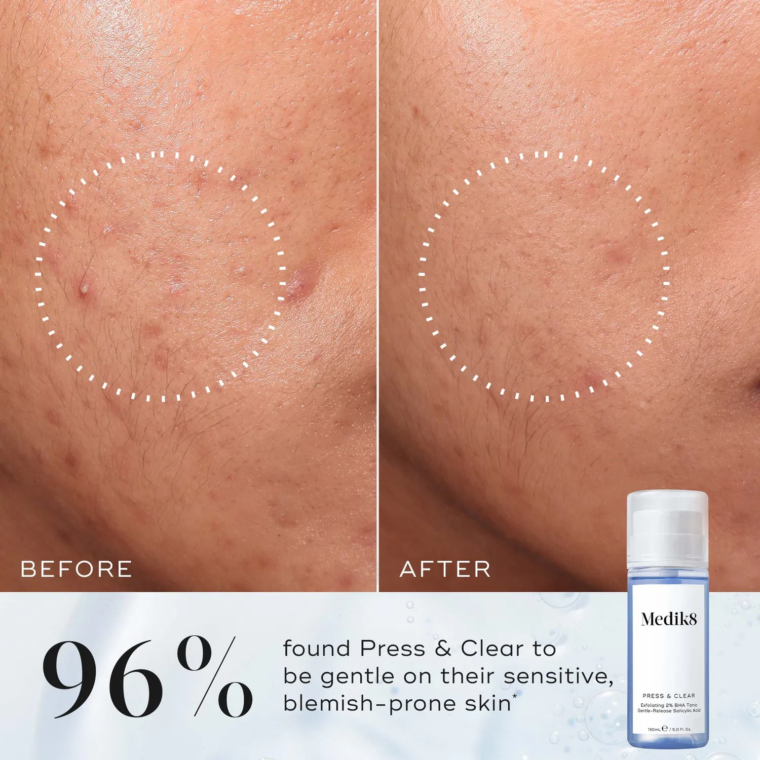 Тоник-эксфолиант с BHA и алоэ вера Medik8 Press and Clear Refill, 150 мл — фото 3