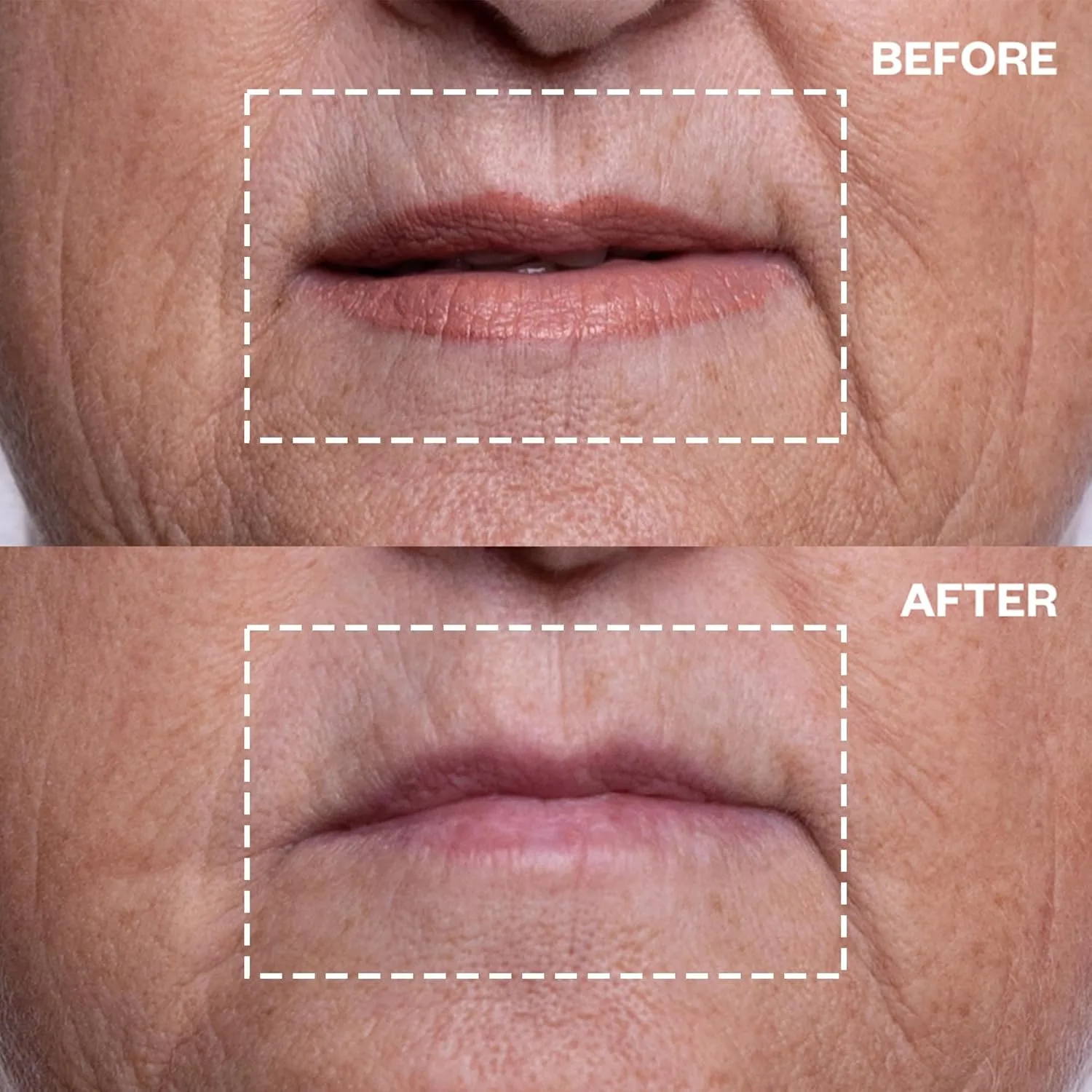 Wrinkles Schminkles патчи для губ и морщин вокруг рта, 1 упаковка, многоразовые гипоаллергенные силиконовые пластыри для сна против морщин 1 штука (1 шт.) — фото 3