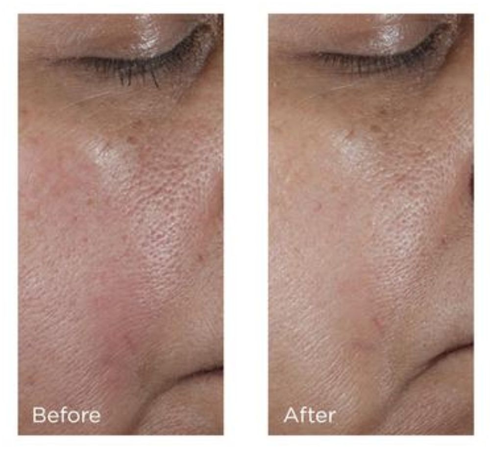 Интенсивный тоник для сужения пор Perricone MD No:Rinse, 118 мл — фото 4