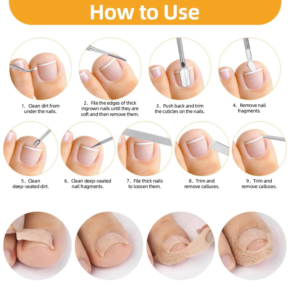 Набор Beugo для вросших ногтей, 110 предметов ‎Beugo, 167 X Toe Nail Correction Plaster Set — фото 3