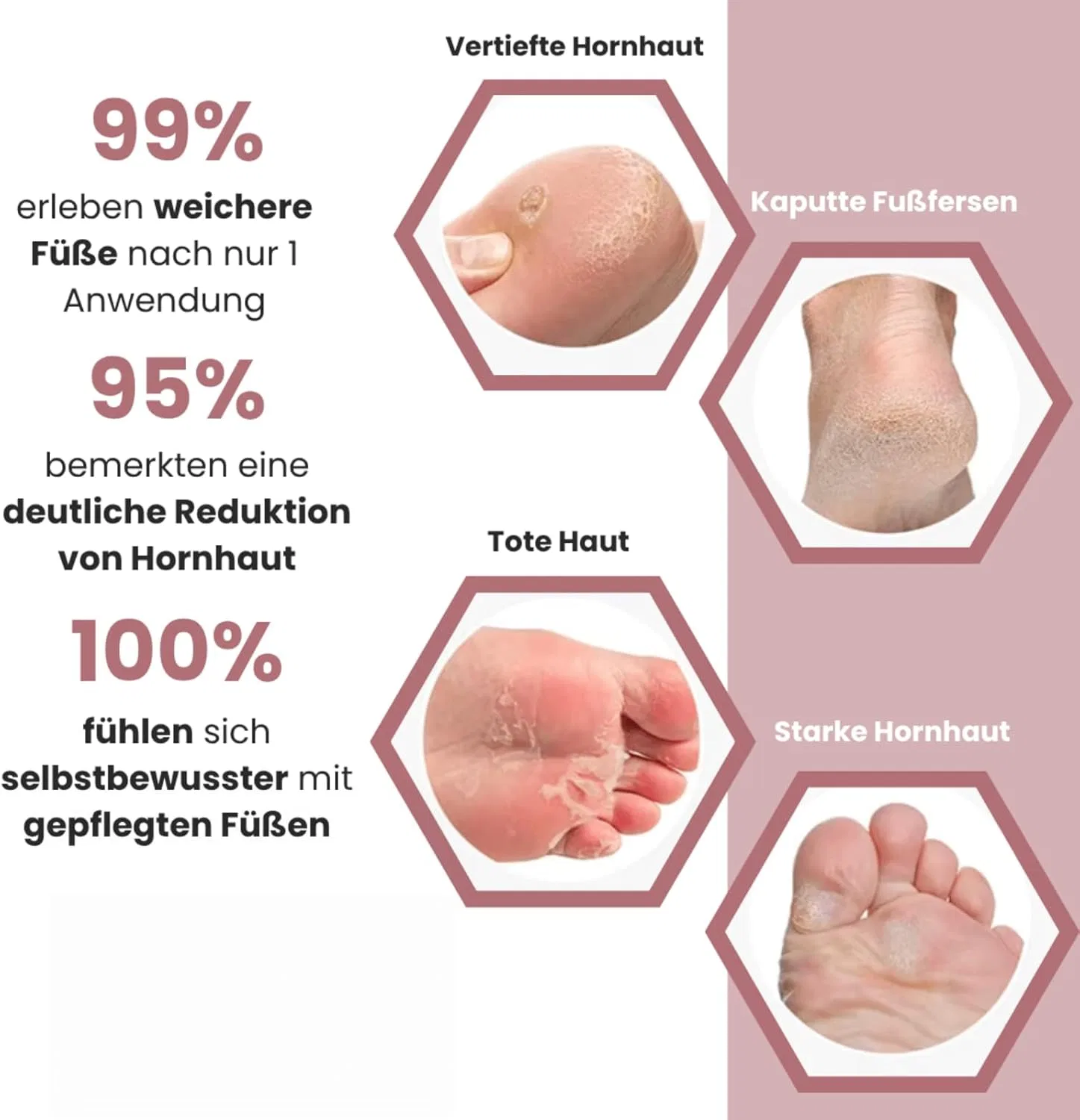 Электрический прибор для удаления мозолей Dermaglide Foot Glow Meiion, Rosa — фото 4
