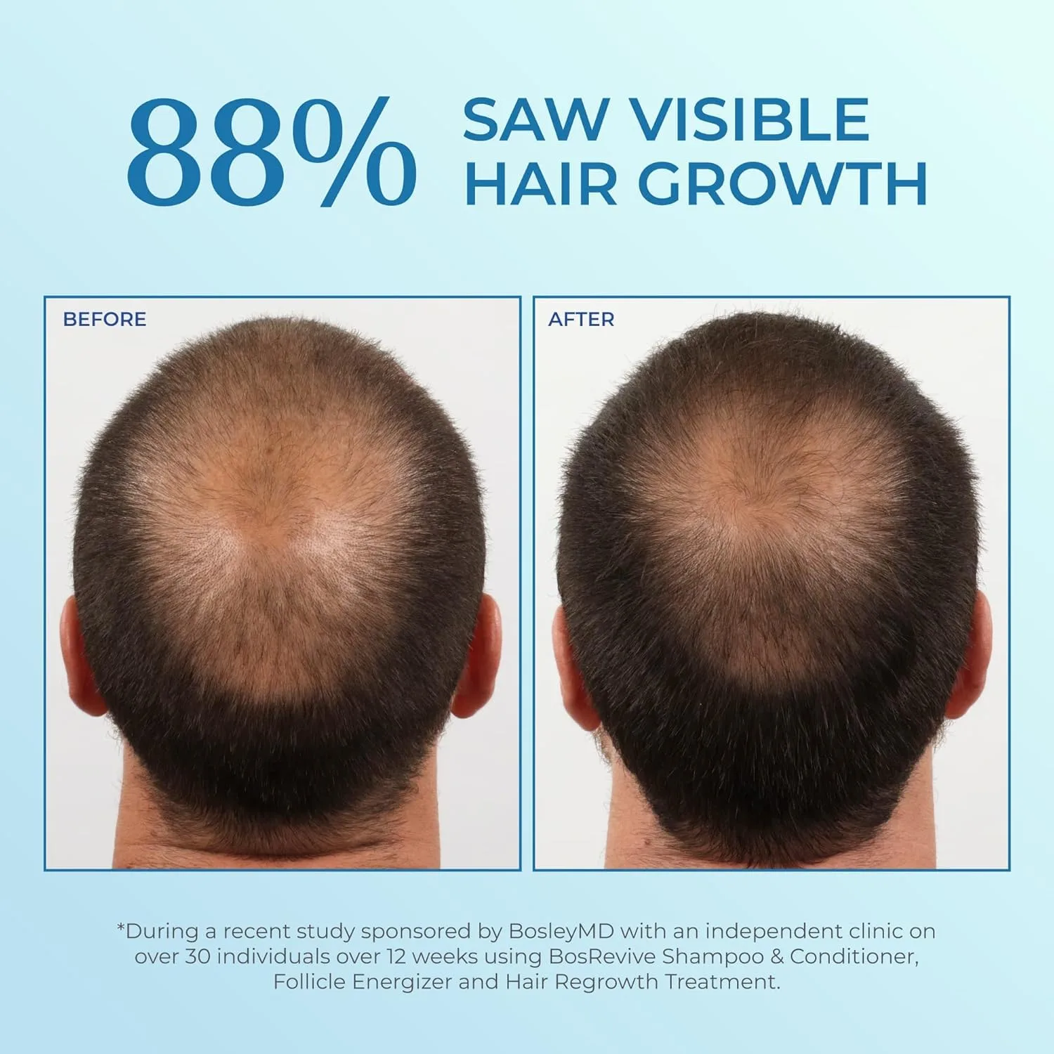 BosleyMD Minoxidil спрей, усиленная формула для истонченных волос и роста волос для мужчин и женщин, 2 упаковки, запас на 2 месяца — фото 3