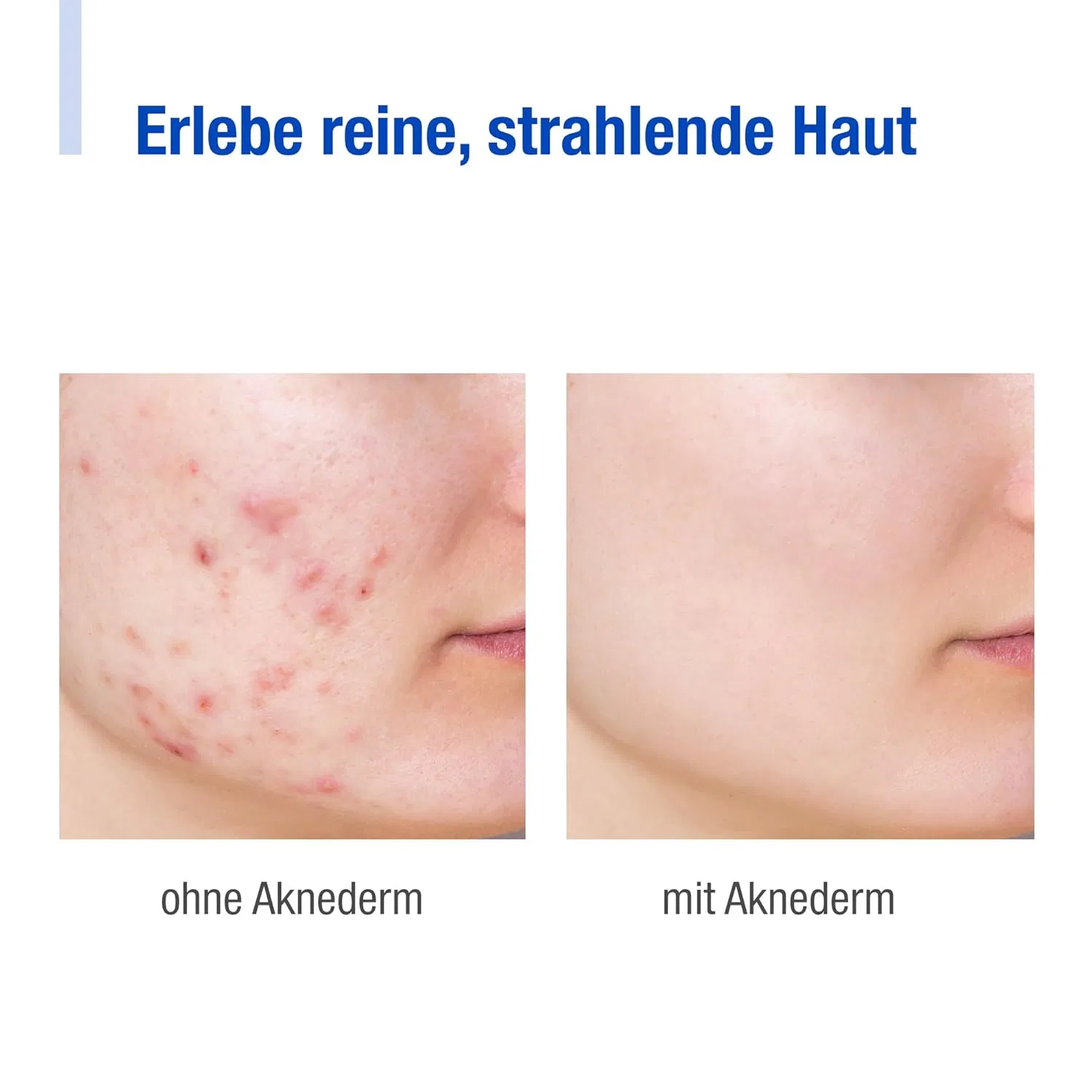Набор для ухода за чувствительной кожей Aknederm Premium Aknederm — фото 4