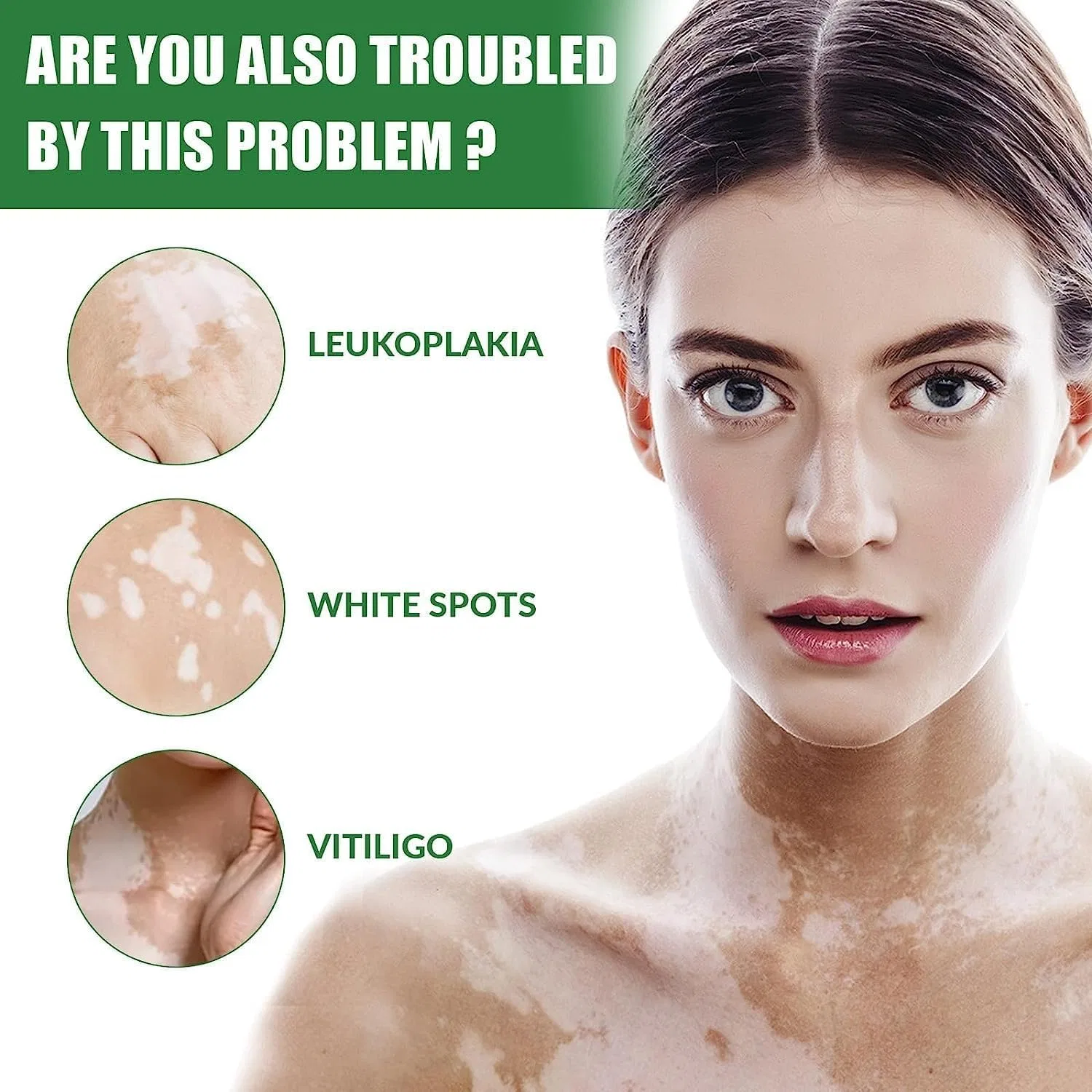 Крем для лица Ashopfun — Для лечения витилиго «Vitiligo Fix Revitalize Elixir» , 3 Pieces, 15 г — фото 2