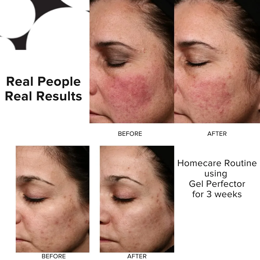 Сыворотка Priori — Skincare гель-корректор для лица от акне, несовершенств, жирной кожи, черных точек, 30 мл — фото 4