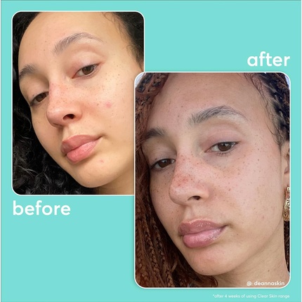 Крем для лица Super Facialist — On The Spot Clarifying Gel Лечение акне с % ниацинамидом Масло чайного дерева Пребиотики, 15 мл — фото 3