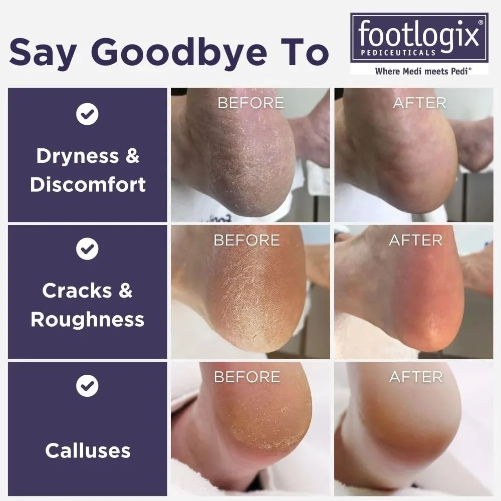 Набор для ухода за стопами Footlogix: спрей Callus Softener и двусторонняя пилка для сухих, грубых и потрескавшихся пяток 1 штука (1 шт.), White — фото 2