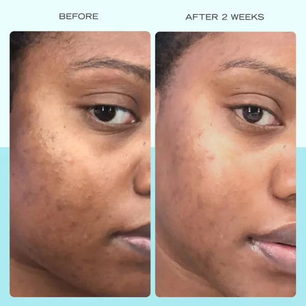 Сыворотка First Aid Beauty — От темных пятен с ниацинамидом — фото 3