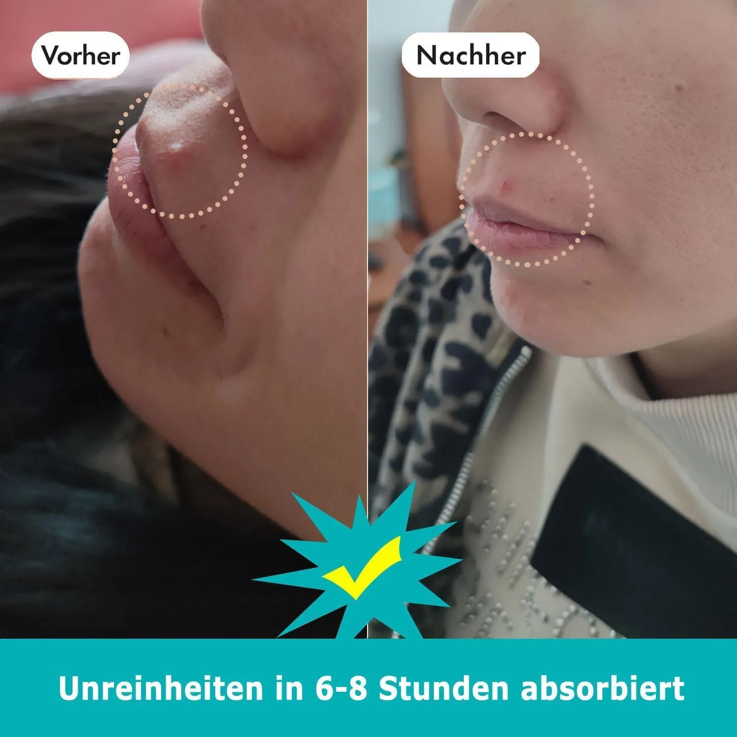 Набор гидроколлоидных патчей от прыщей с салициловой кислотой и ниацинамидом (216 шт.) Cgboom — фото 3