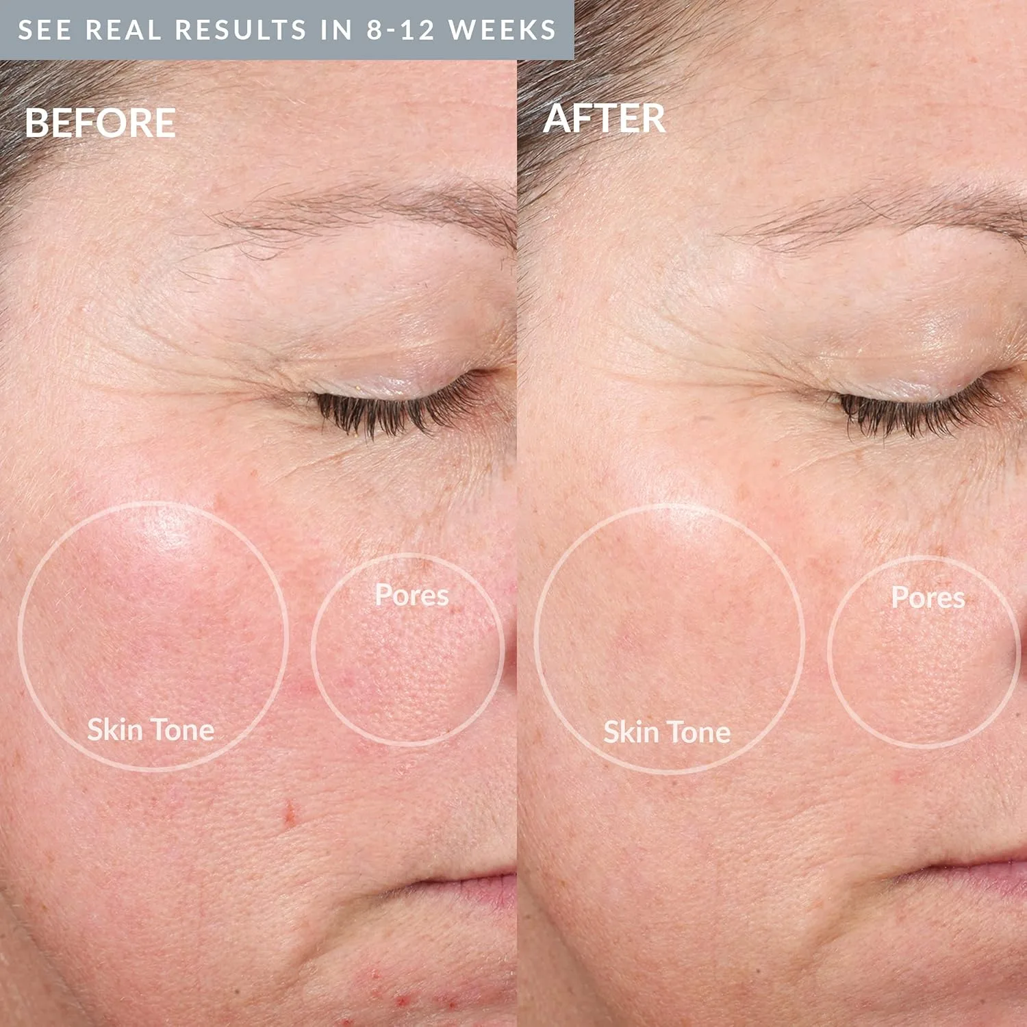PMD Beauty Personal Microderm Elite Pro - Инструмент для микродермабразии лица и тела для домашнего использования., London Fog Grey + Large Kit — фото 4
