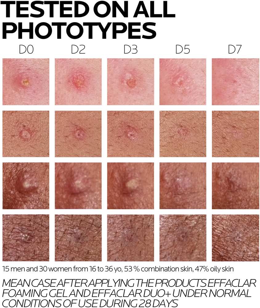 Набор La Roche-Posay — SPF effaclar duo (+m) корректор несовершенств кожи и следов от прыщей , 40 мл — фото 4