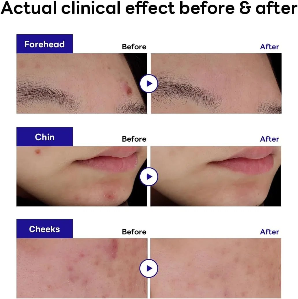 Патчи для лица MEDIHEAL Derma Clear Blemish Spot Patch с мадекассосидом, 44 шт — фото 3