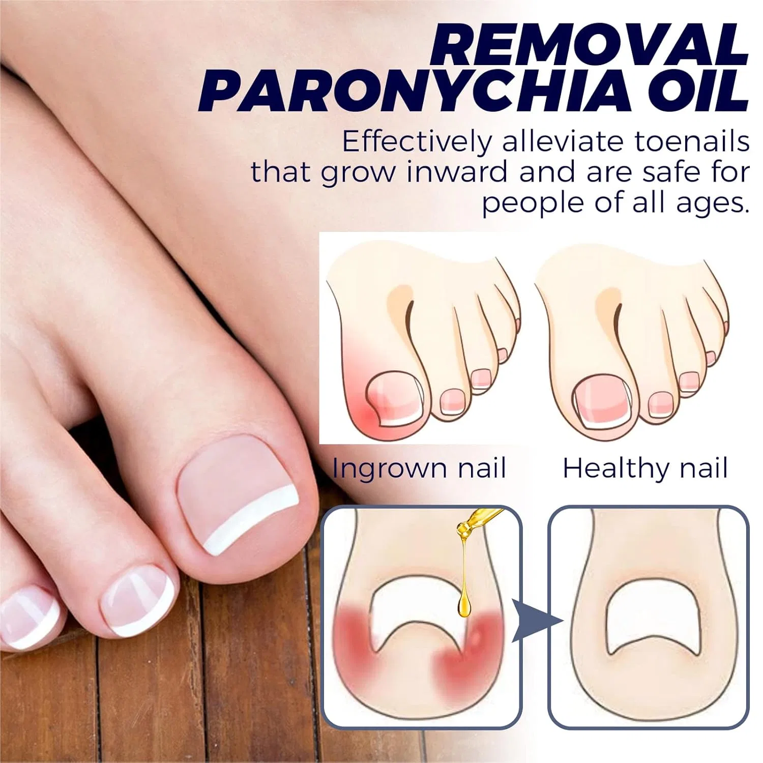 Масло German Toenailcare Removal Paronychia Oil для ухода за ногтями, 10 мл Sovtay, 1Pcs — фото 3
