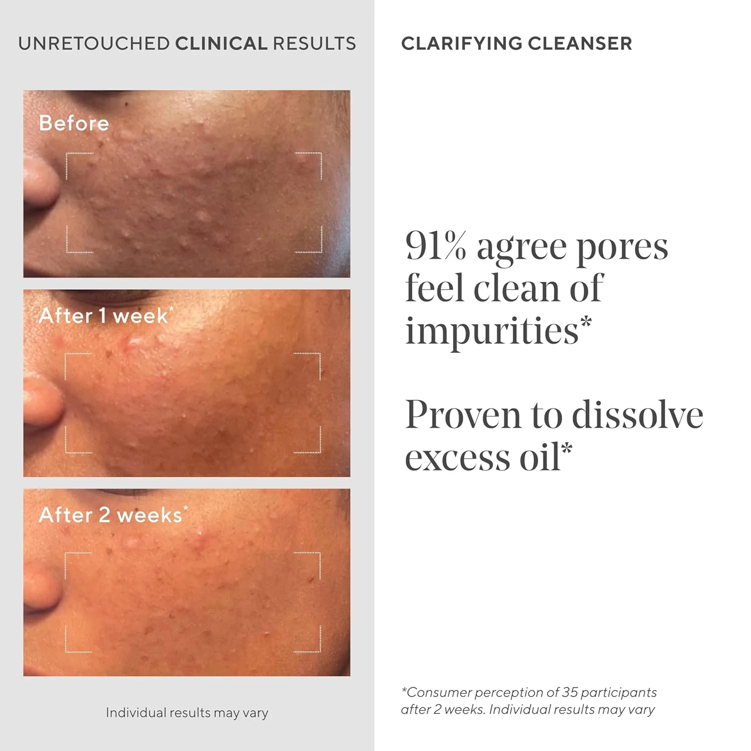 Гель для умывания Murad — Acne Control Clarifying Cleanser с салициловой кислотой и зеленым чаем для очищения пор, 500 мл — фото 4