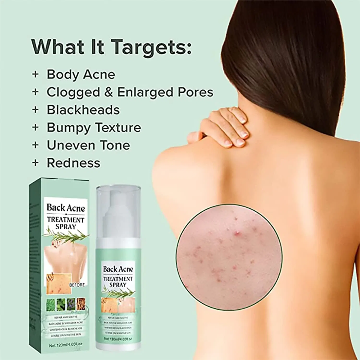 Спрей для лечения акне на спине Toxiklenz Back Acne Treatment Spray, 120 мл (3 шт.) ‎Sovtay, 3 Pieces. — фото 3