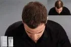Оптимизатор линии роста волос Kö-HAIR для загустителя волос ‎Köhair — фото 4