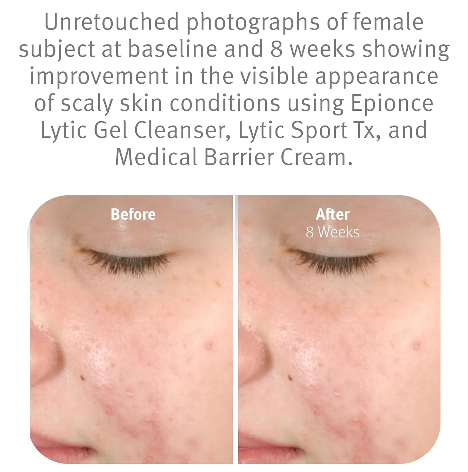 Гель для умывания Epionce — Lytic Gel Cleanser - нежное пенящееся средство для умывания и снятия макияжа для жирной — фото 4