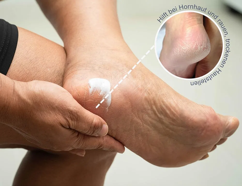 Бальзам DermaAktiv для уменьшения мозолей, 75% за 28 дней Hydas — фото 3