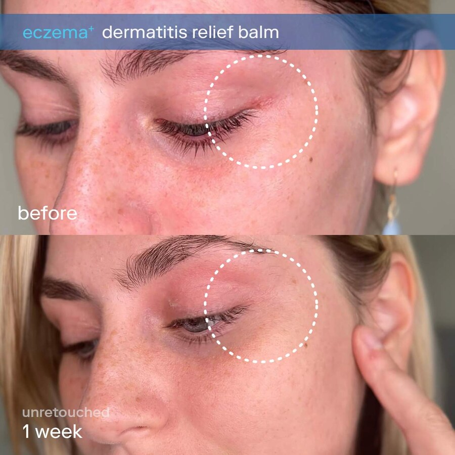 Крем для лица Skinfix — И тела с церамидами от экземы и дерматита, 50 мл — фото 3