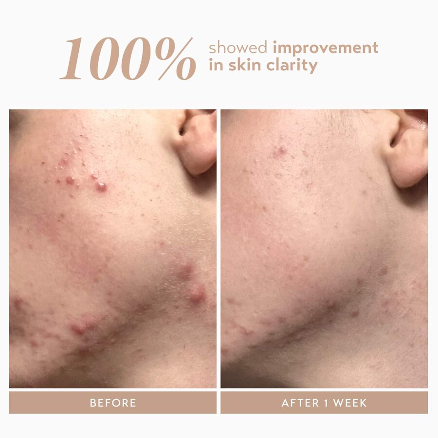 Сыворотка Shani Darden Skin Care — Восстанавливающая с % азелаиновым комплексом для борьбы с пигментными пятнами, 30 мл — фото 3