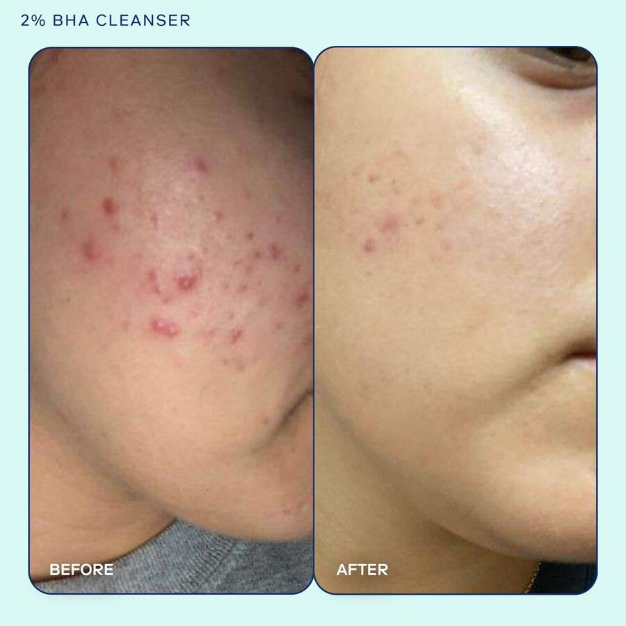 Гель для умывания Skinfix — Акне+ % BHA + азелаиновая кислота + ниацинамид + очищающее средство с AHA, 148 мл — фото 3