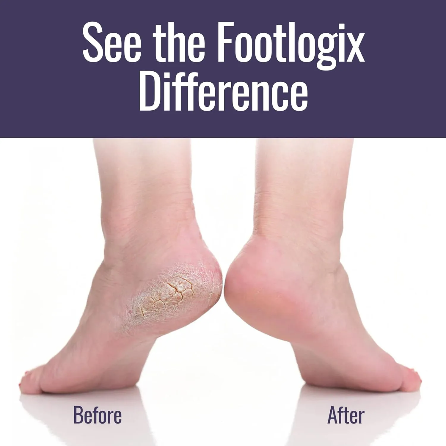 Набор для ухода за ногами Footlogix Foot Care Callus Softener Combo: спрей для удаления мозолей и двусторонняя пилка для сухих, потрескавшихся пяток, инструменты для педикюра, скраб для ног. Комбо, White — фото 4