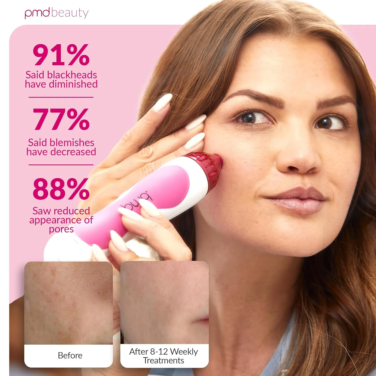 PMD Beauty Personal Microderm Classic - Набор для домашнего использования, инструмент для отшелушивания кожи лица, микродермабразия для ухода за кожей лица и тела. Pmd Personal Microderm, Pink — фото 4