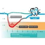 Кариекс стоматологический спрей 50мл Quattroti Dentech - фото 3
