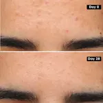 Гель для лечения акне Sephora Collection - фото 3