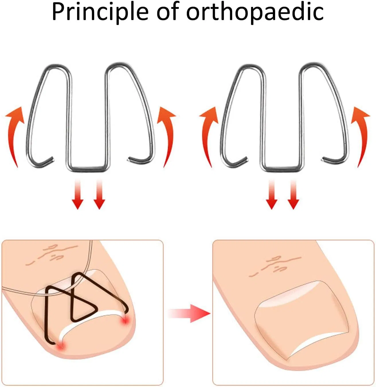 Набор корректоров для вросших ногтей ‎Tmishion — фото 3