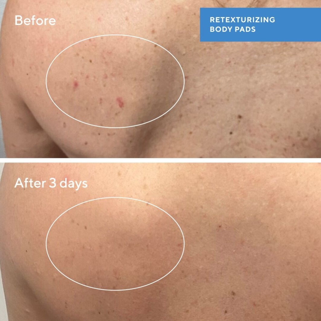 Скраб для тела blemish control retexturizing body pads Murad, количество 1 шт. — фото 4