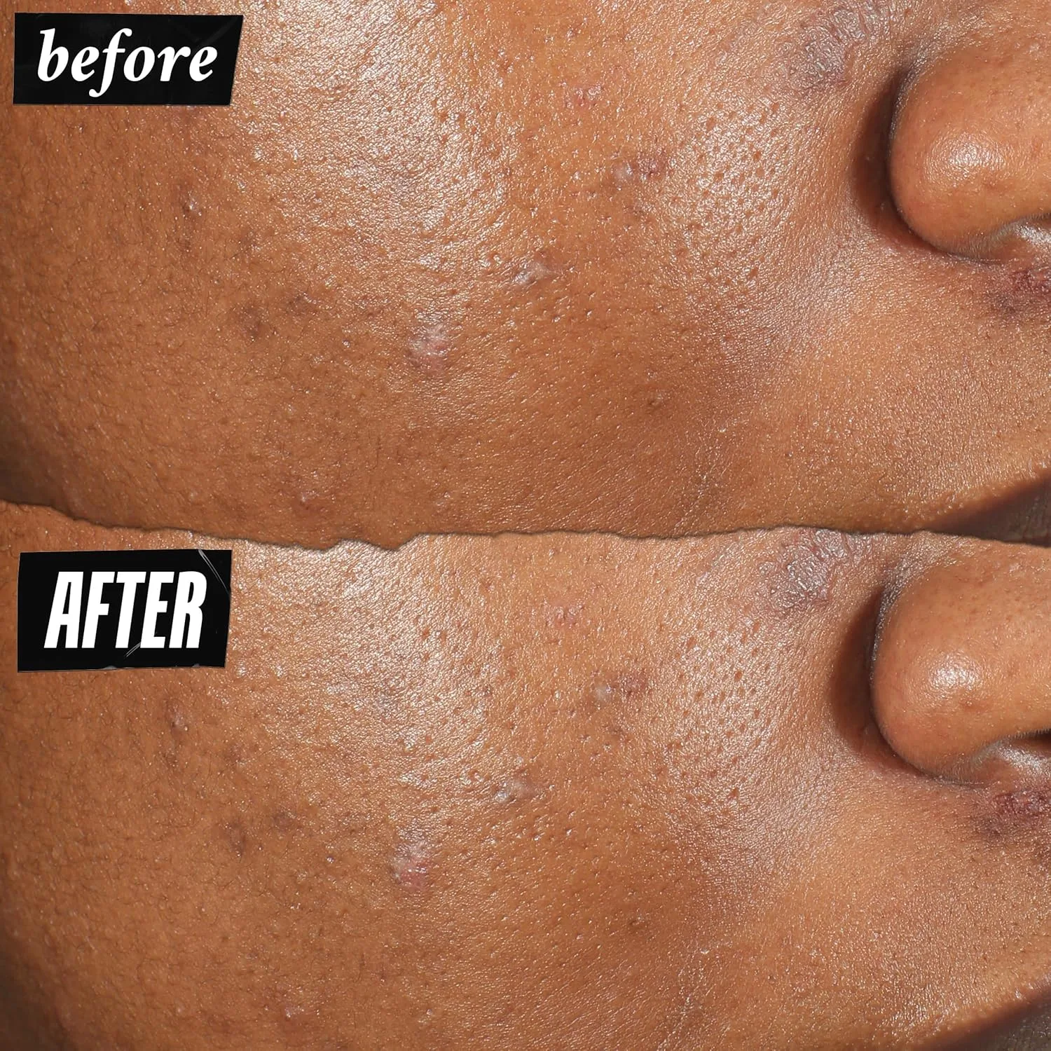 Kiehl's Truly Targeted Acne-Clearing Pimple Patch с 2% салициловой кислотой, невидимое жидкое средство для точечного применения, 4% ниацинамид для осветления следов, 0.2% корень солодки для снятия покраснений - 15 мл — фото 3
