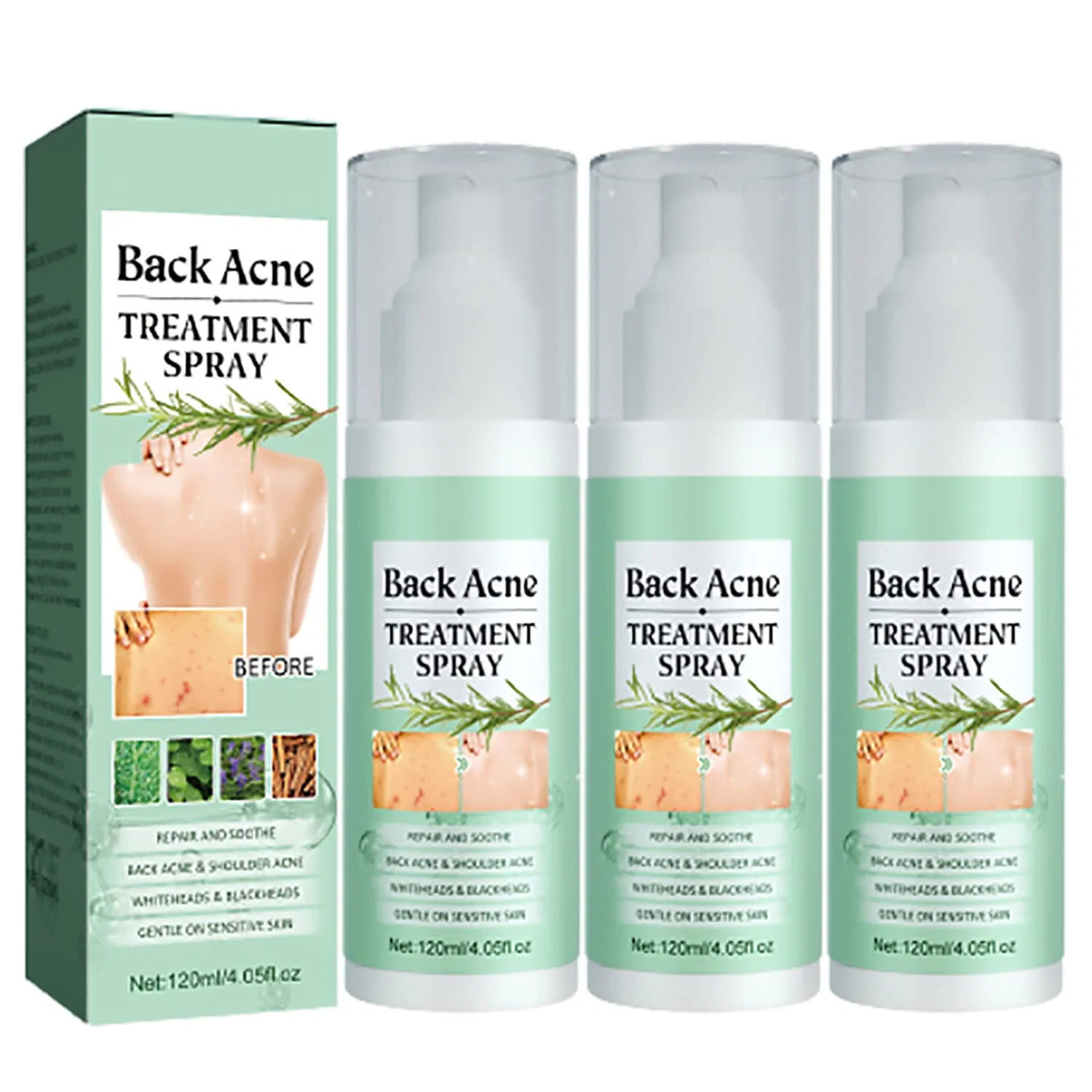Спрей для лечения акне на спине Toxiklenz Back Acne Treatment Spray, 120 мл (3 шт.) Sovtay, 3 Pieces.