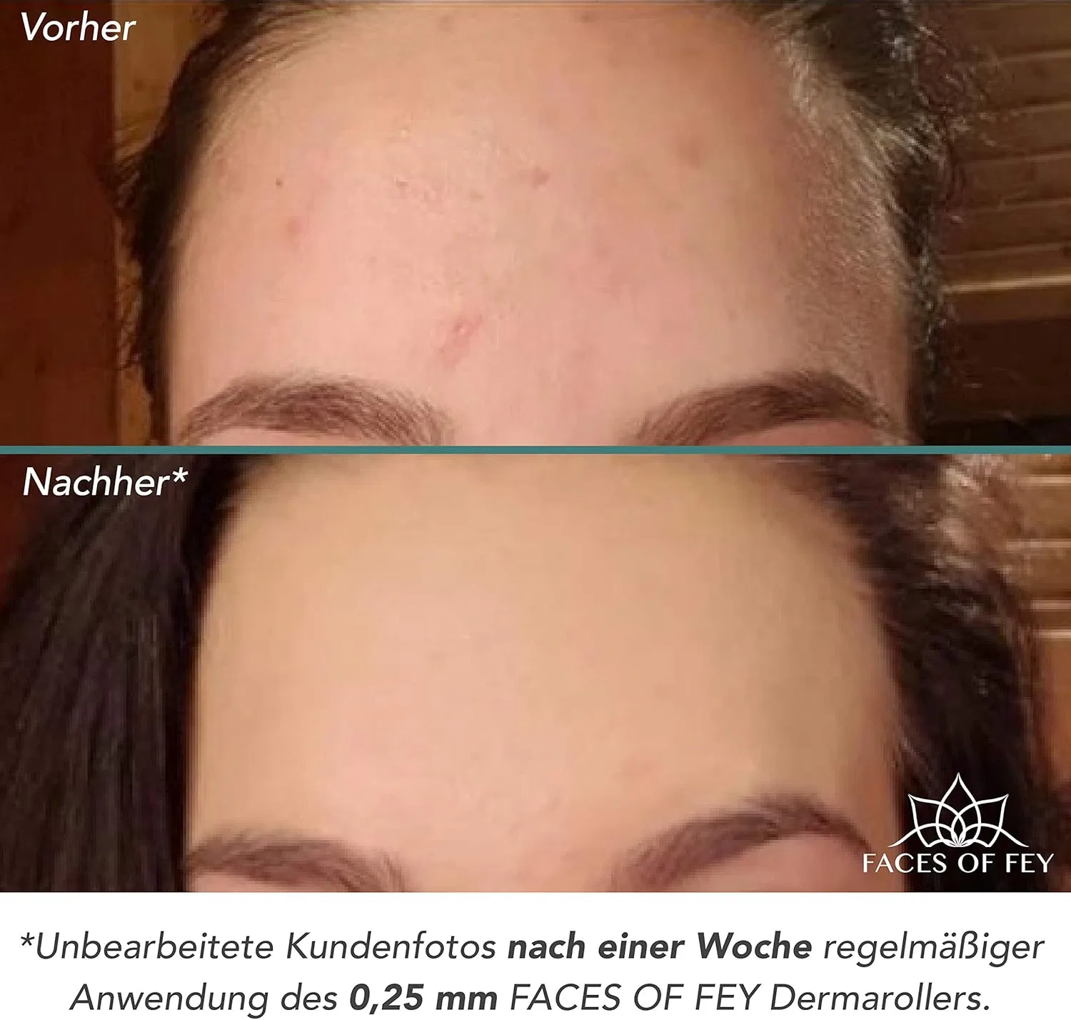 Набор для микронидлинга Faces of Fey Dermaroller с 192 иглами для лица и тела Faces Of Fey — фото 2