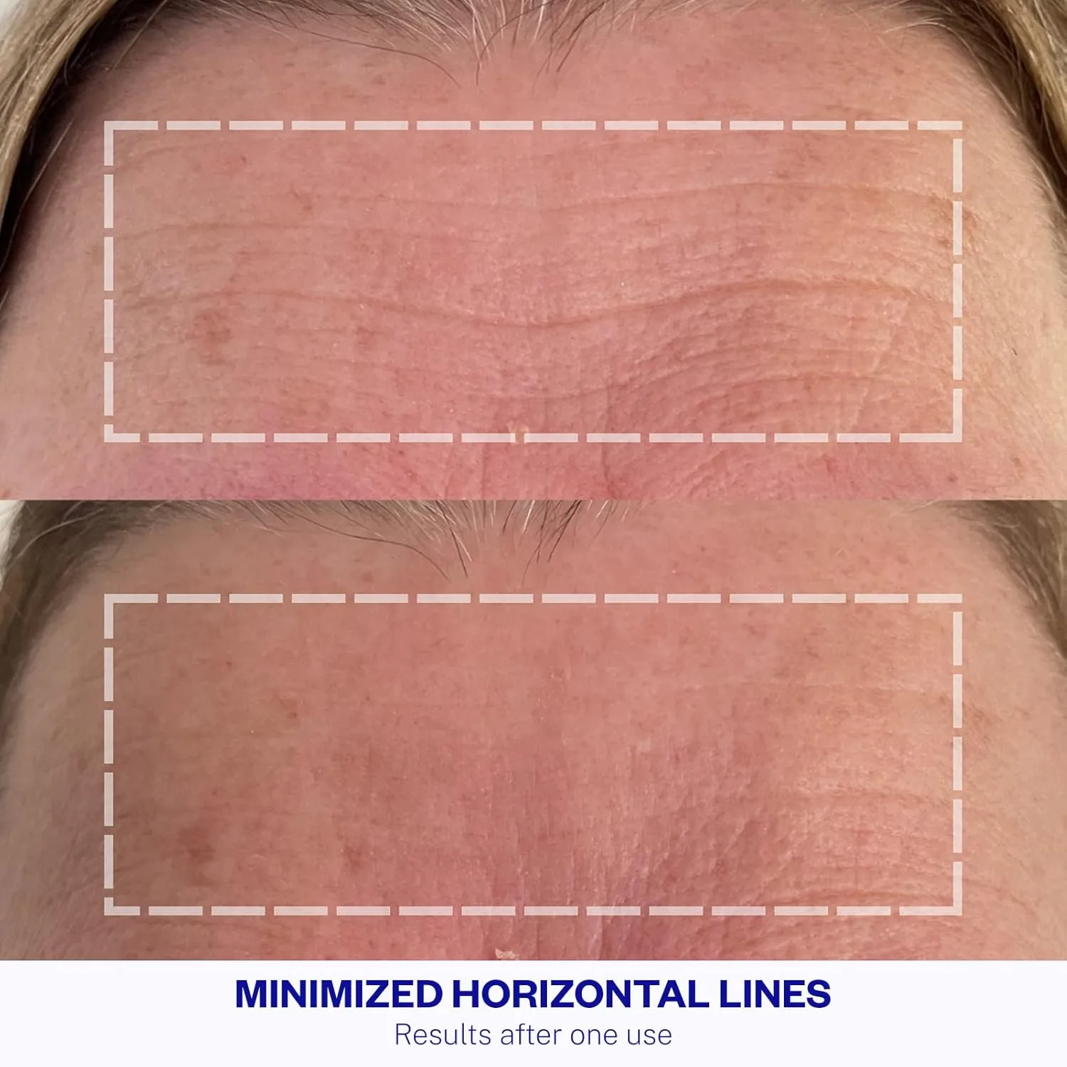Набор силиконовых пластырей для разглаживания морщин на лбу Wrinkles Schminkles + очищающее средство для пластырей. — фото 2
