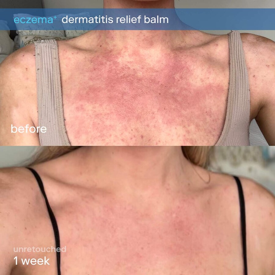 Крем для лица Skinfix — И тела с церамидами от экземы и дерматита, 50 мл — фото 2